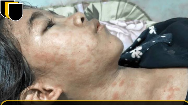 Chikungunya virus